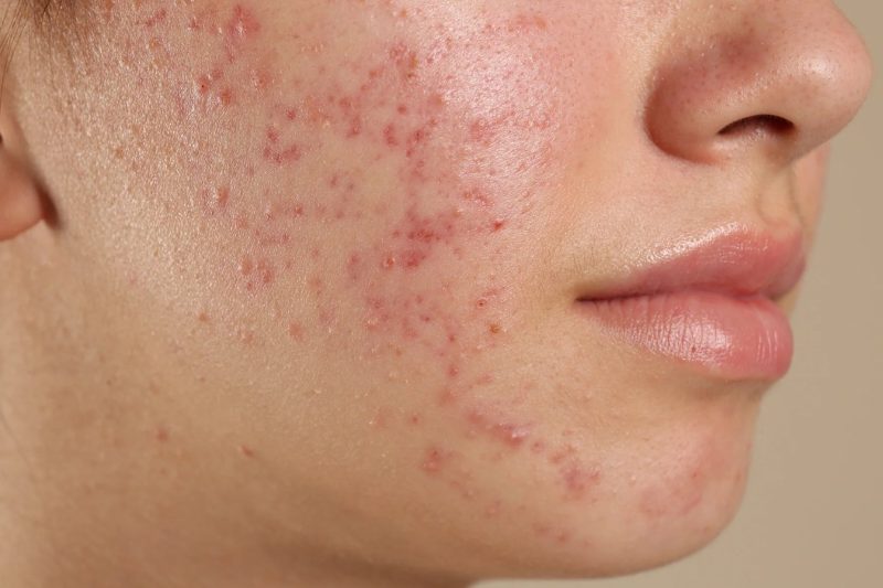 Jerawat Hormon – Memahami Kitaran, Punca,Diet, dan Solusi Rawatan Dalaman