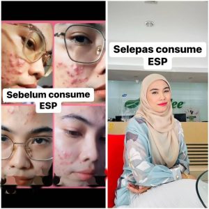esp shaklee kulit teruk jadi cantik