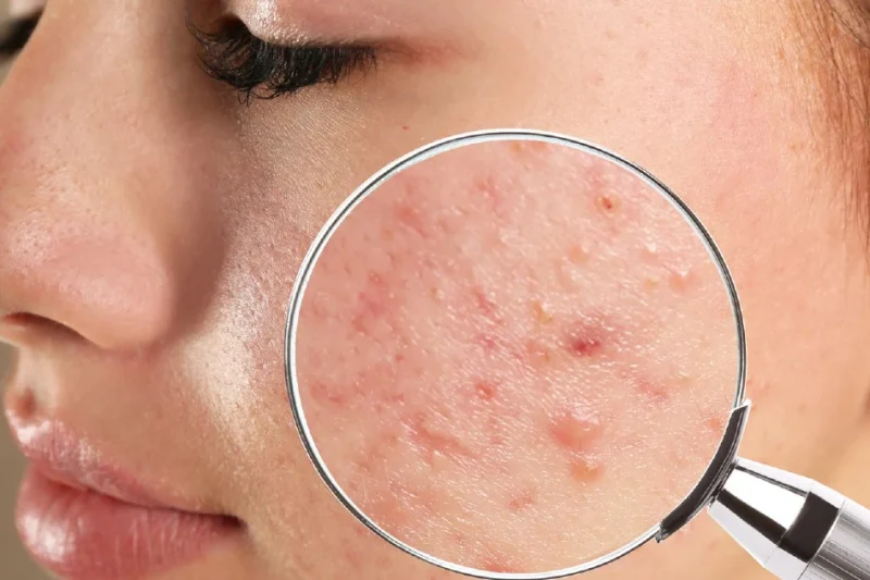 Masalah Jerawat Tak Selesai? Temui Solusi Holistik Luaran dan Dalaman Bersama Shaklee