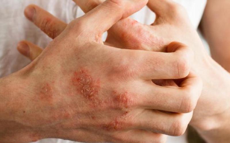 Inflamasi Kronik Eczema Mengganggu – Panduan Lengkap Solusi Semulajadi