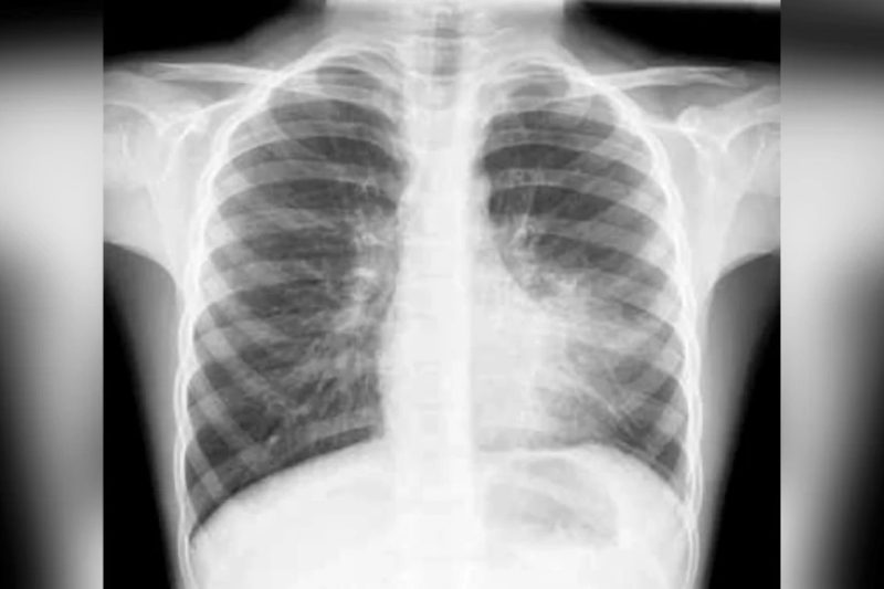 Jangkitan Paru-Paru: Apa Yang Doktor Tidak Sempat Beritahu Anda