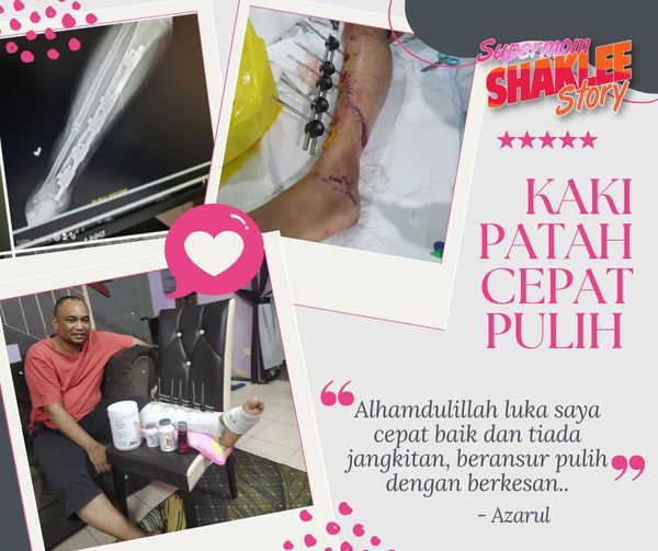 kaki patah cepat pulih